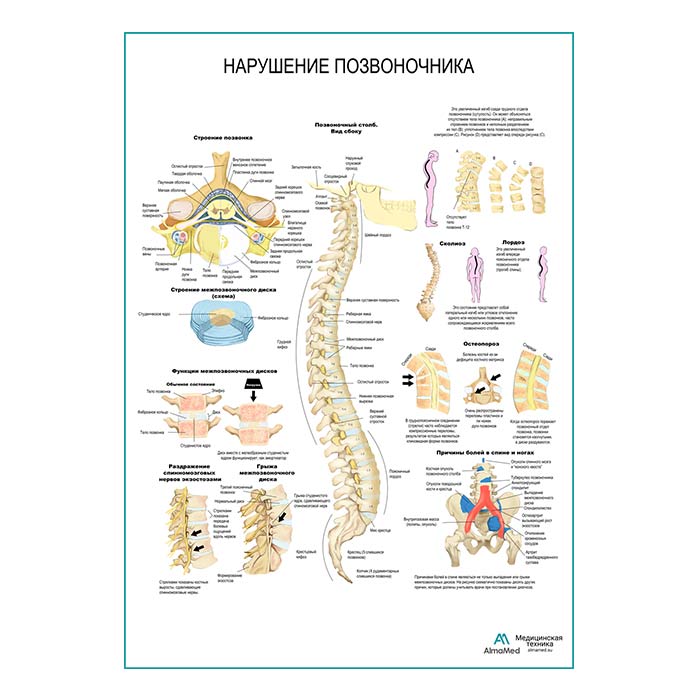 Нарушения позвоночника плакат глянцевый А1+/А2+