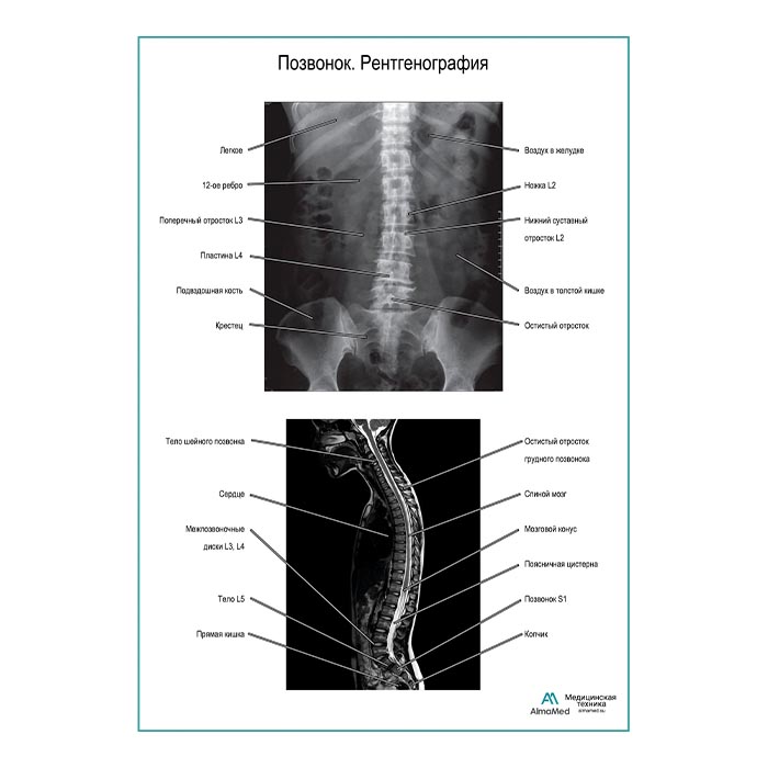 Позвонок. Рентгенография плакат глянцевый  А1+/А2+