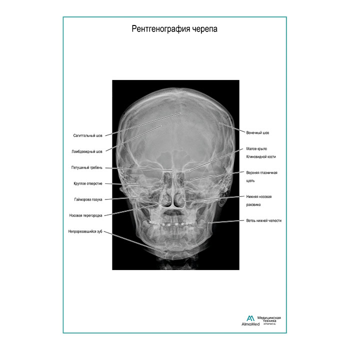 Рентгенография черепа плакат глянцевый А1+/А2+