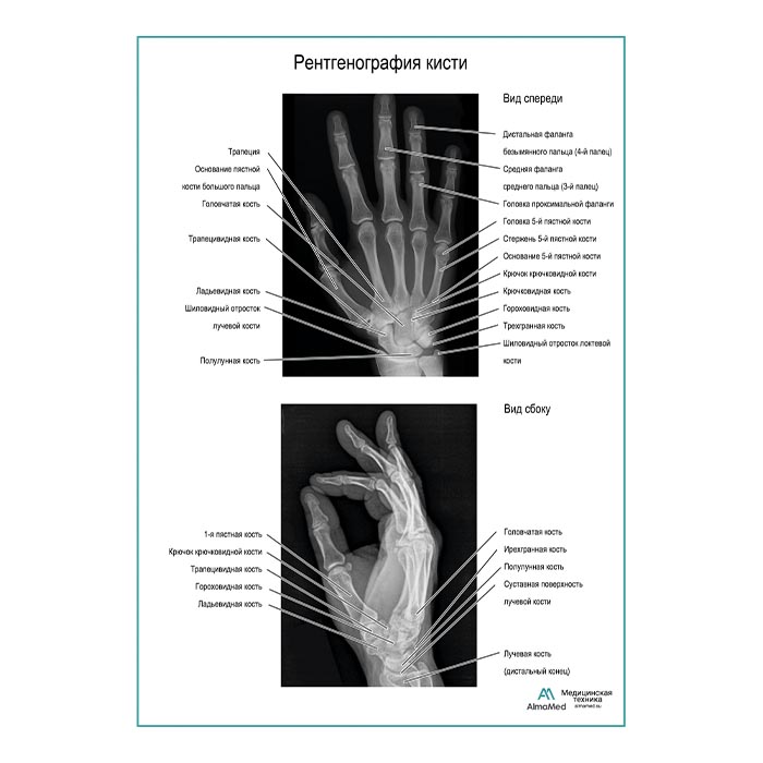 Рентгенография кисти плакат глянцевый А1+/А2+